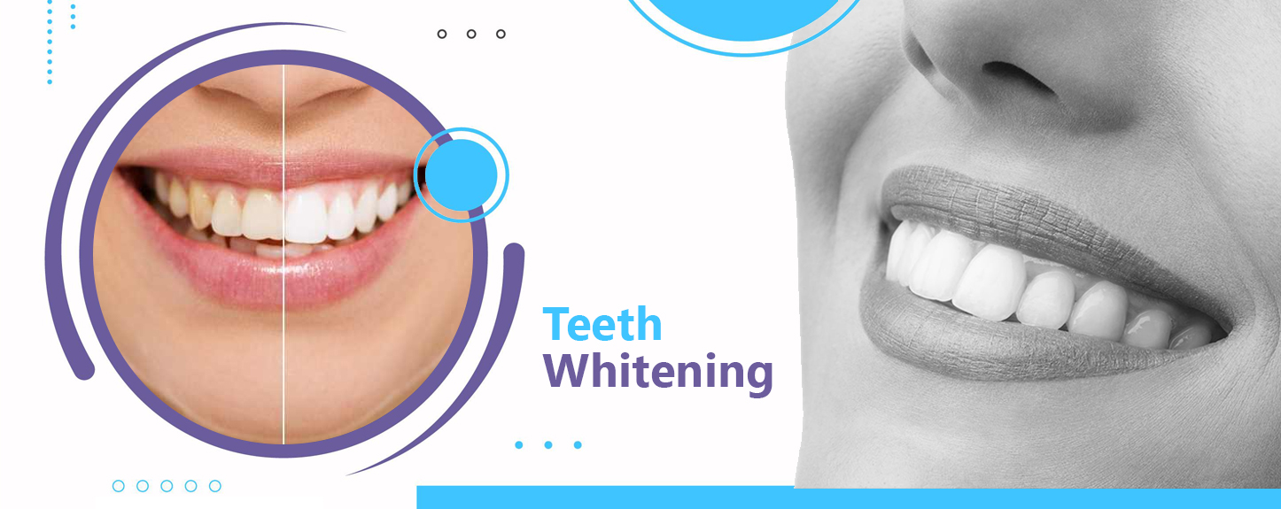 Best Teeth Whitening Treatment