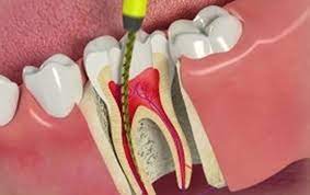 BEST SINGLE VISIT ROOT CANAL TREATMENT