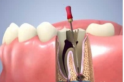 SINGLE VISIT ROOT CANAL TREATMENT
