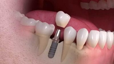 Best Dental Implant Centre