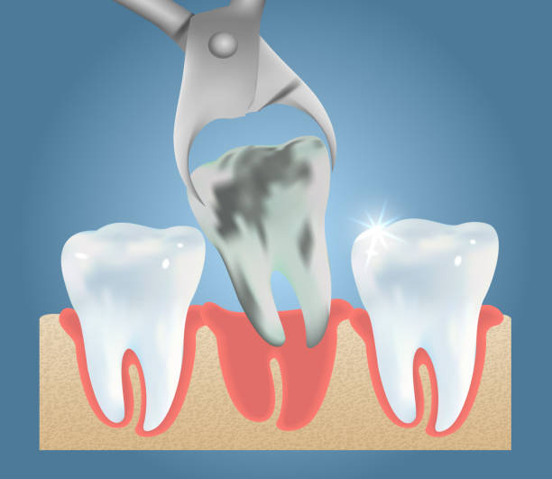 Wisdom Tooth Extraction Clinic