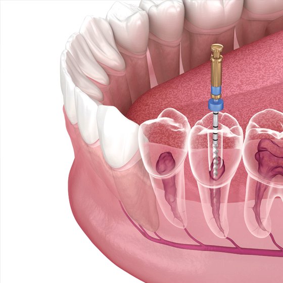 SINGLE VISIT ROOT CANAL TREATMENT