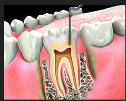 Best Single Visit Root Canal Treatment